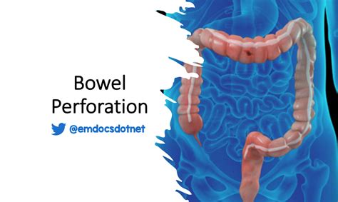 test for colon tear|gastrointestinal perforation test.